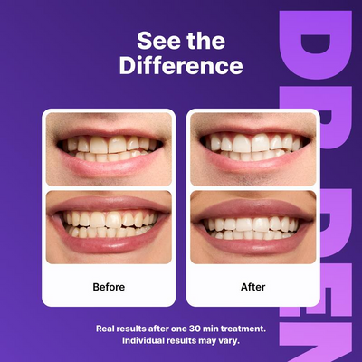 Teeth Whitening Strips - Peroxide-Free