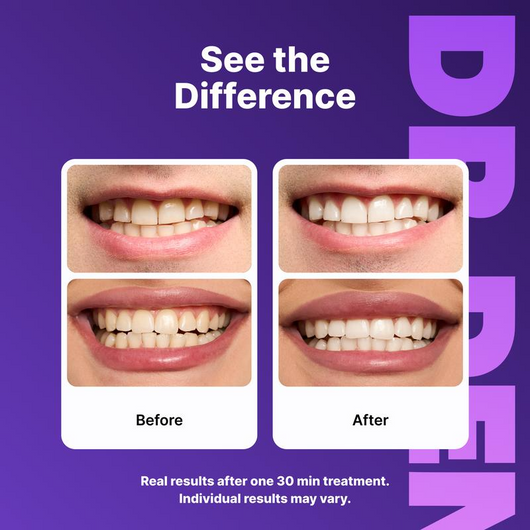 Teeth Whitening Strips - Peroxide-Free